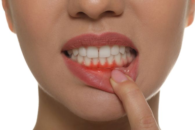 Strenthening Weak Gums